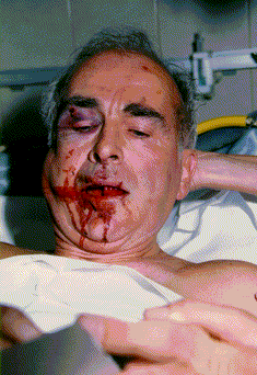 faurisson-face-smashed